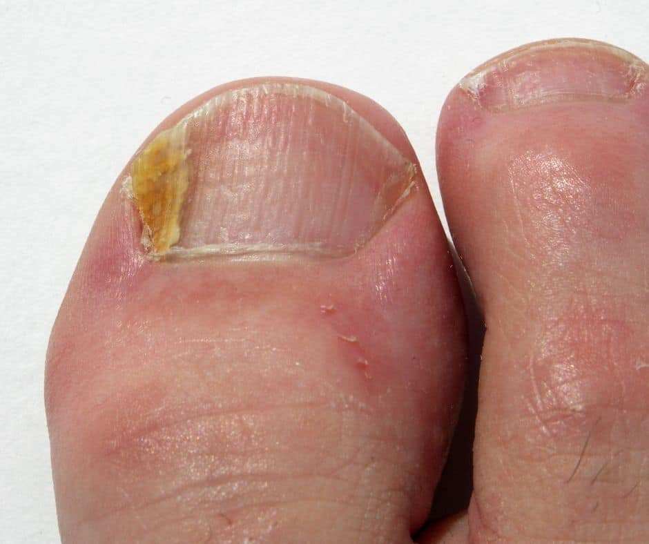 fungal toenail