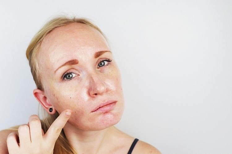 sebaceous filaments vs blackheads