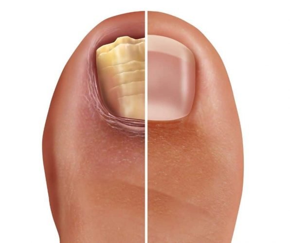 fungal nail fungal nail